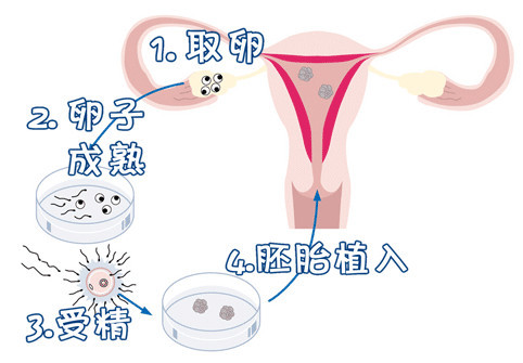体外受精 IVF-ET