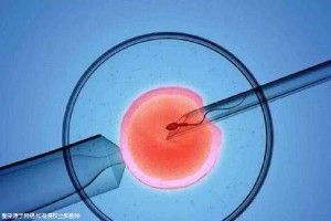 顕微授精 ICSI